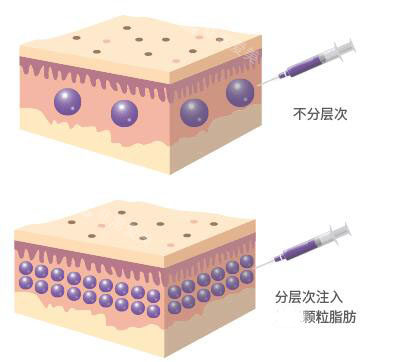 深圳兰茂梵美面部脂肪填充优势