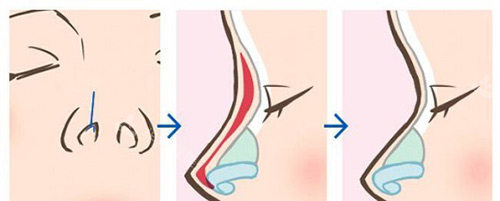 隆鼻手术动画示意图