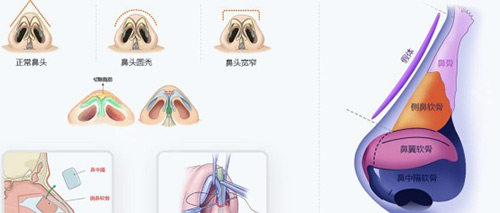 隆鼻手术示意图