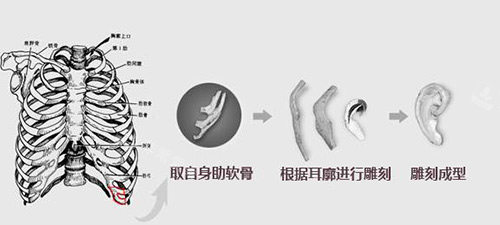 隆鼻肋软骨材料示意图