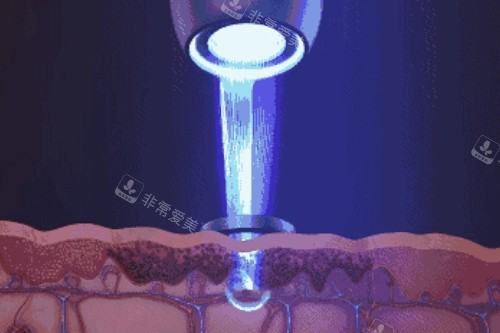 皮秒激光宣傳圖