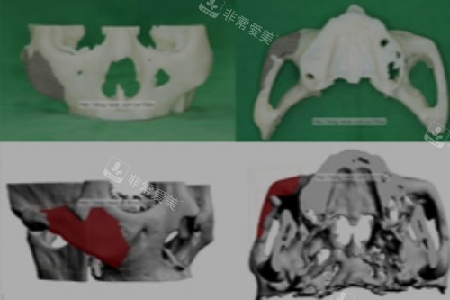 轮廓手术宣传图