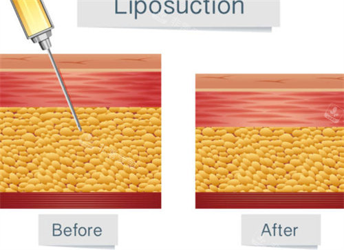 分层吸脂示意图