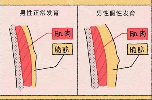 男性胸部正常發(fā)育與假性發(fā)育