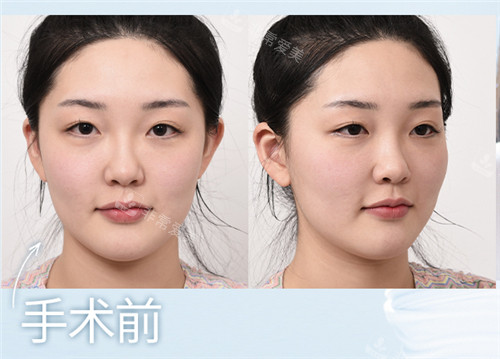 韓國GNG整形醫(yī)院眼鼻整形術(shù)前圖 韓國GNG整形醫(yī)院眼鼻整形術(shù)前圖