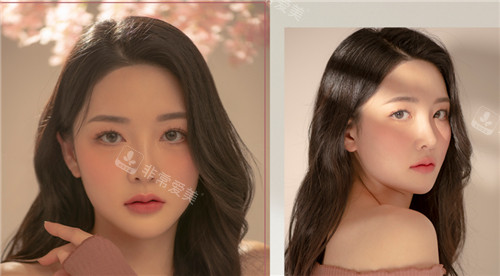 韩国GNG整形医院眼鼻整形术后变化