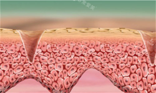 疤痕皮肤示意图