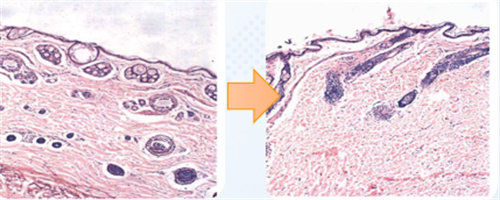 表皮細(xì)胞恢復(fù)圖