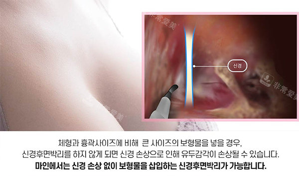 韩国麦恩隆胸手术方式