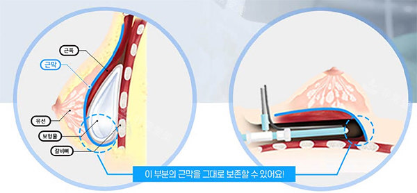 韩国隆胸手术方法图片
