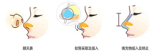 乌鲁木齐黎美整形医院鼻子整形图 乌鲁木齐黎美整形医院鼻子整形图