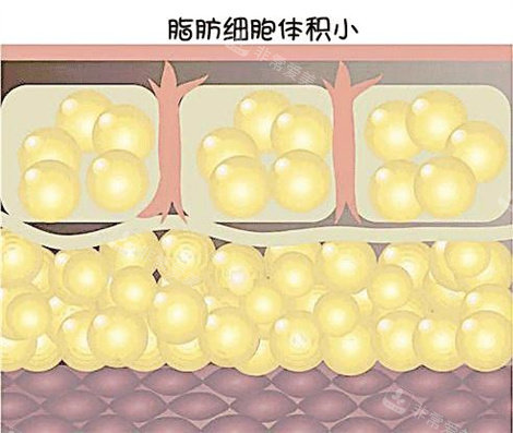 乌鲁木齐黎美整形医院吸脂示意图 乌鲁木齐黎美整形医院吸脂示意图