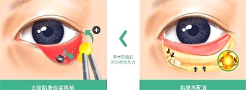 眼部整形示意图 眼部整形示意图