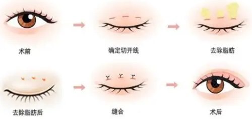 雙眼皮手術過程 雙眼皮手術過程