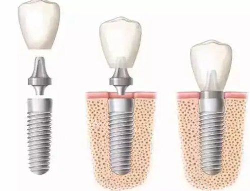 种植牙过程示意图