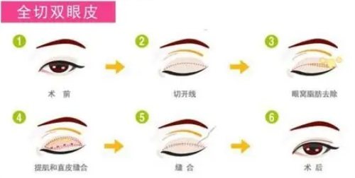 全切雙眼皮示意圖 全切雙眼皮示意圖