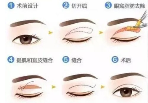雙眼皮過程示意圖 雙眼皮過程示意圖