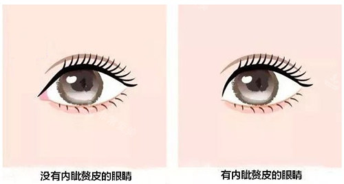 內(nèi)眥贅皮示意圖 內(nèi)眥贅皮示意圖