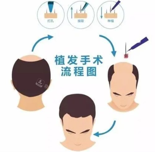 植發(fā)手術(shù)流程圖 植發(fā)手術(shù)流程圖