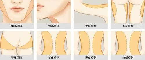 身體各部位吸脂 身體各部位吸脂