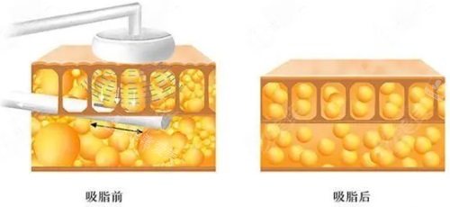 吸脂前后脂肪细胞对比