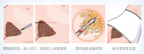 腰腹吸脂示意圖 腰腹吸脂示意圖