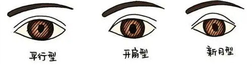 不同類型雙眼皮展示圖 不同類型雙眼皮展示圖