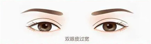 雙眼皮過款動(dòng)畫示例圖 雙眼皮過款動(dòng)畫示例圖
