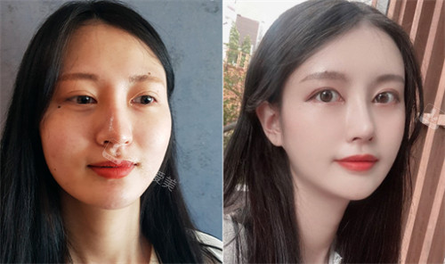 韓國GNG整形外科輪廓整形前后 韓國GNG整形外科輪廓整形前后