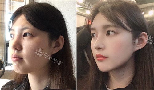 韓國GNG整形外科輪廓整形前后對比 韓國GNG整形外科輪廓整形前后對比