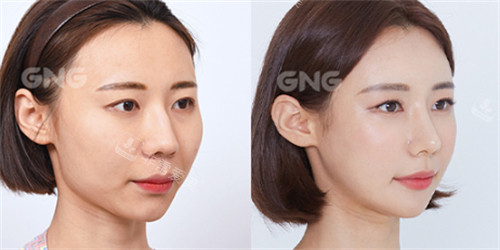 韩国GNG整形外科轮廓整形前后对比照