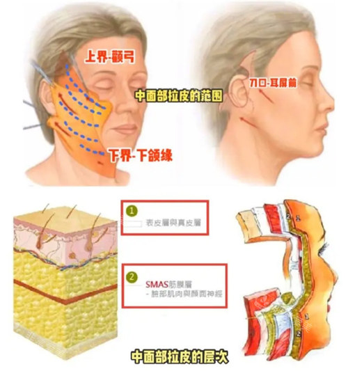 面部拉皮展示圖