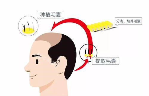 植發(fā)過程圖 植發(fā)過程圖
