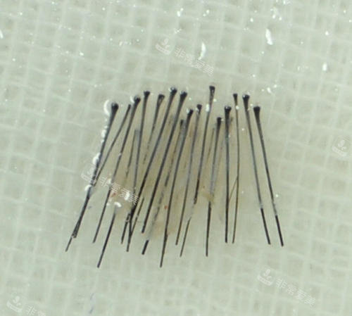 植發(fā)示意圖 植發(fā)示意圖