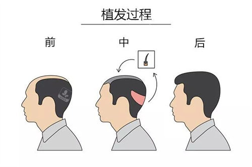 植發(fā)過程卡通圖 植發(fā)過程卡通圖