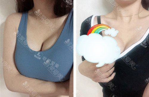 在韓國(guó)歌柔飛做假體隆胸375cc圖 在韓國(guó)歌柔飛做假體隆胸375cc圖
