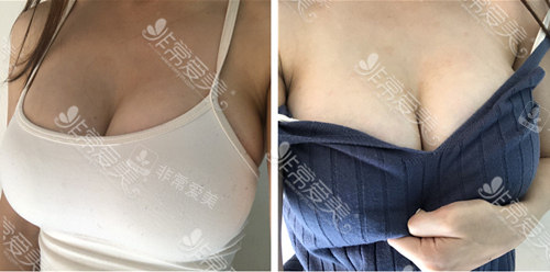 375cc的假體隆胸恢復(fù)好圖片 375cc的假體隆胸恢復(fù)好圖片
