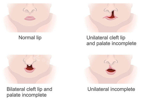 唇裂类型图示