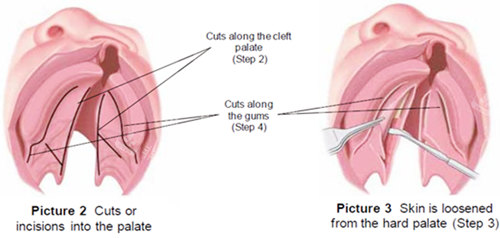 唇裂修复手术图示