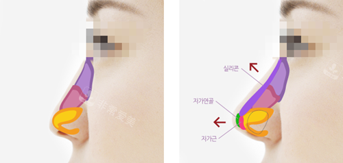 韩国温度整形外科鼻部整形七问七答,做鼻子这些必须得了解