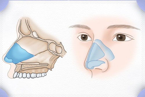 鼻子手术卡通图