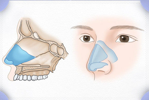 韩国温度整形外科鼻部整形七问七答,做鼻子这些必须得了解