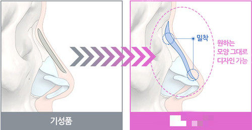 鼻假体位置图示