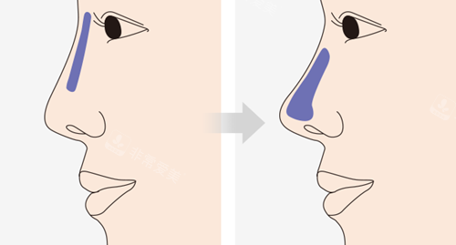 鼻部综合整形图示