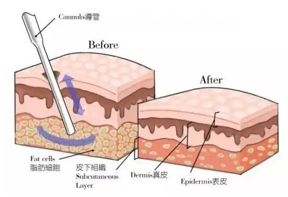 吸脂手術(shù)原理