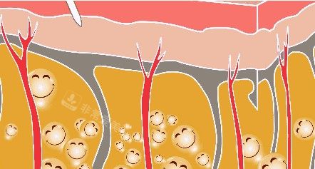 吸脂手术原理