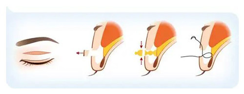 双眼皮手术