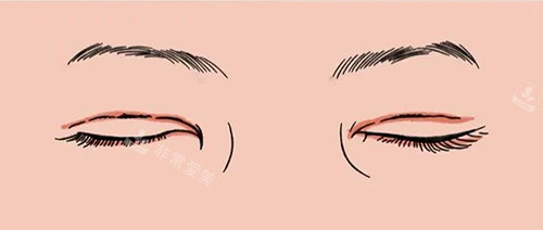 雙眼皮疤痕明顯 雙眼皮疤痕明顯