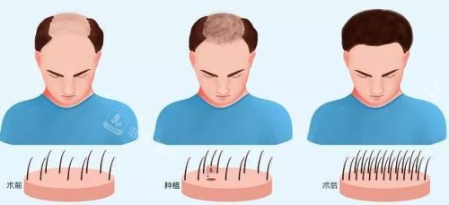 植發(fā)毛囊生長過程