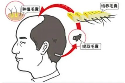 種植毛囊示意圖